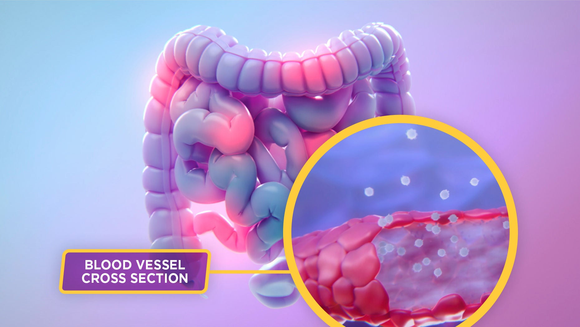 Inflamed intestine with a magnified cross-section of a blood vessel.
